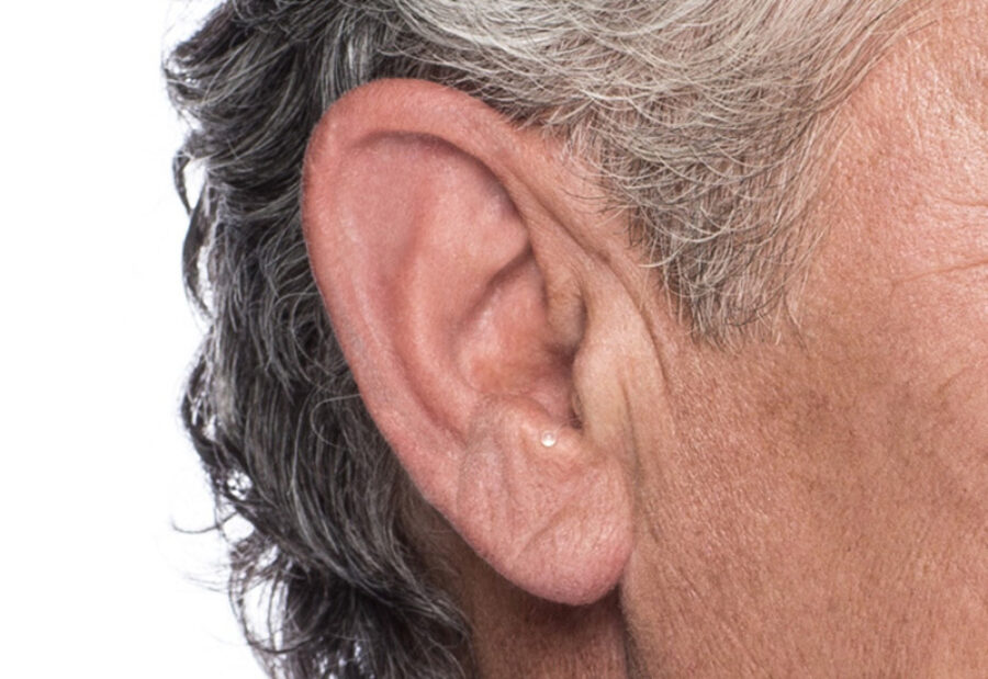 Front view of a CIC (Completely In Canal) hearing aid being worn